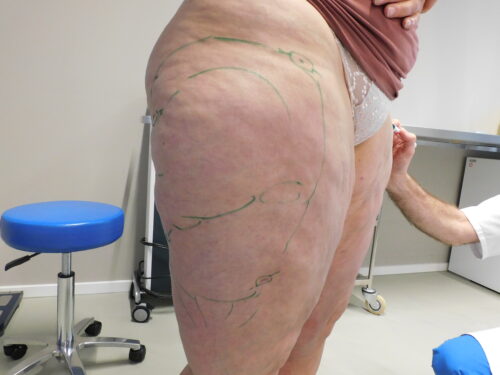 Liposuctie specialist lipoedeem