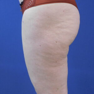 Nationaal Huidcentrum Lipoedeem behandeling voor verwijderen onderhuids vetweefsel