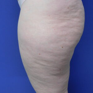 Nationaal Huidcentrum Lipoedeem behandeling voor verwijderen onderhuids vetweefsel