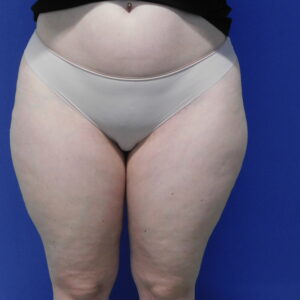 Nationaal Huidcentrum Lipoedeem behandeling voor verwijderen onderhuids vetweefsel