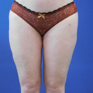 Nationaal Huidcentrum Lipoedeem behandeling voor verwijderen onderhuids vetweefsel