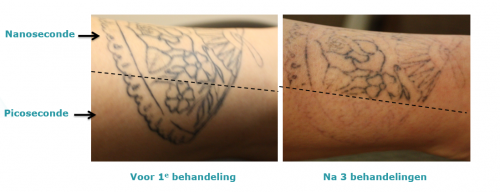 gedeelte van arm met tatoeage voor 1 behandeling en na 3 behandelingen met verschillende lasers