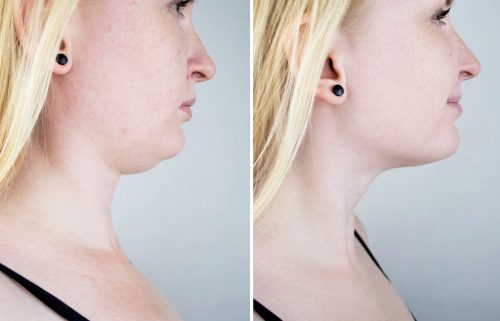 Jonge vrouw voor en na een kaaklijnverstrakking met kinliposuctie
