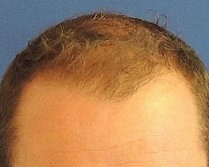 na haartransplantatie