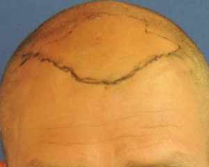 voor haartransplantatie