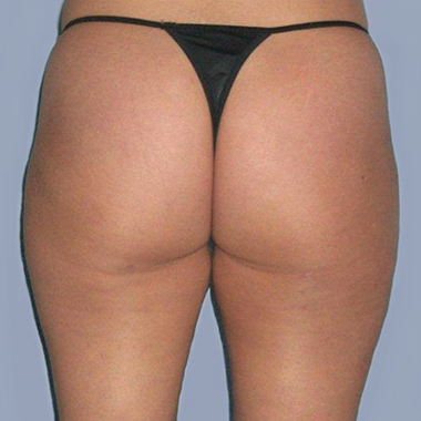 Nationaal Huidcentrum Liposuctie: veilige behandeling door ervaren chirurgen