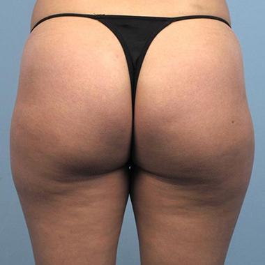 Nationaal Huidcentrum Liposuctie: veilige behandeling door ervaren chirurgen