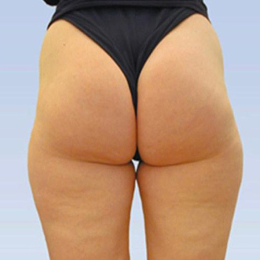 Nationaal Huidcentrum Liposuctie: veilige behandeling door ervaren chirurgen