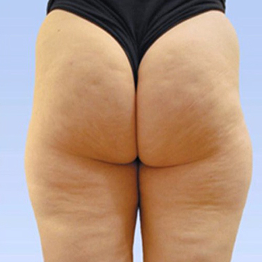Nationaal Huidcentrum Liposuctie: veilige behandeling door ervaren chirurgen