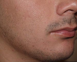 voor haartransplantatie