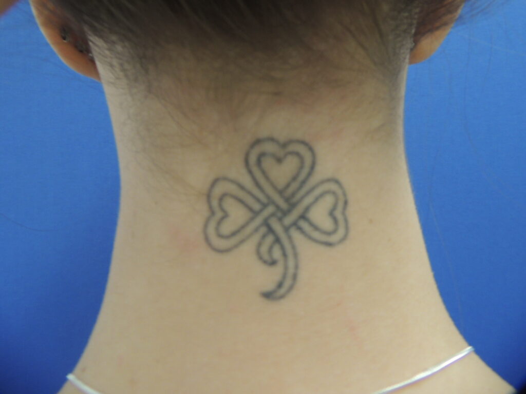 Nationaal Huidcentrum Tatoeage verwijderen: Laat je tattoo verwijderen