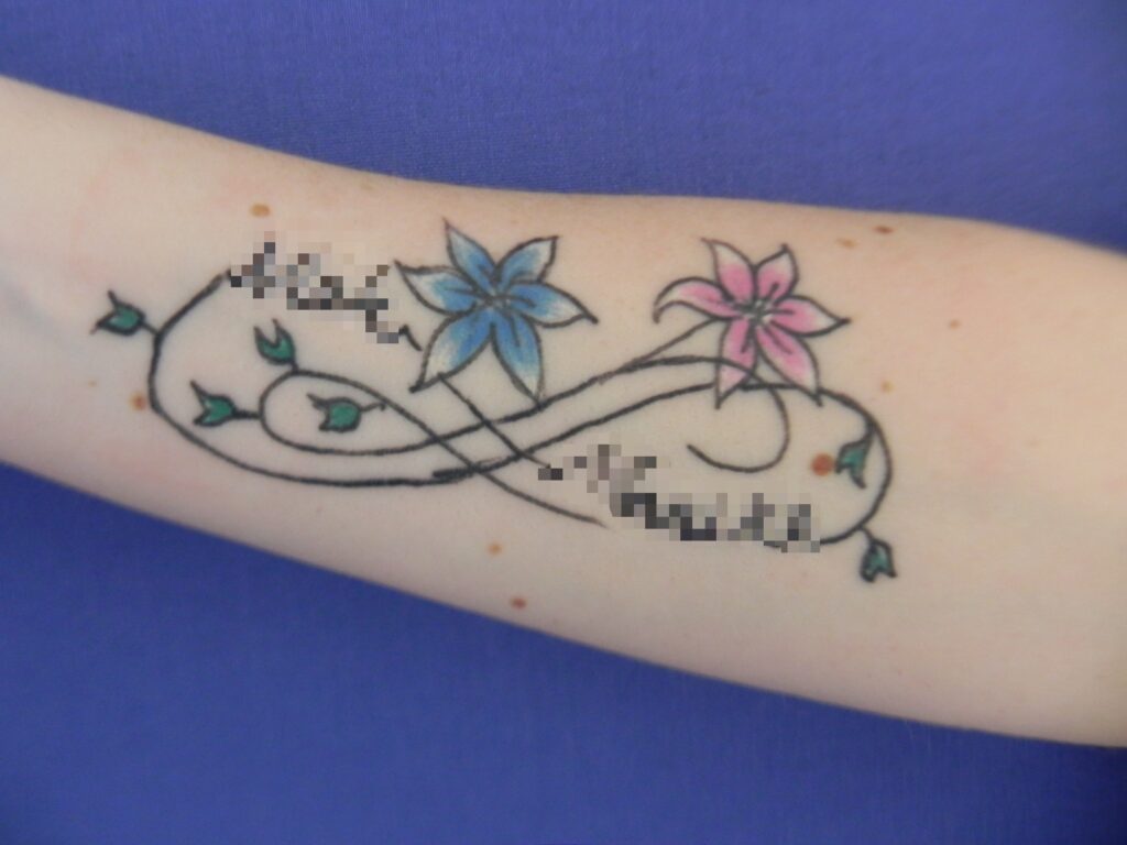 Nationaal Huidcentrum Tatoeage verwijderen: Laat je tattoo verwijderen