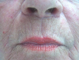 Nationaal Huidcentrum Fractionele CO2 laserbehandeling (laserpeeling)
