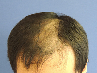 Nationaal Huidcentrum FUE Haartransplantatie en haarimplantatie