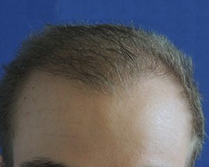 na haartransplantatie