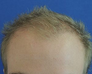 voor haartransplantatie