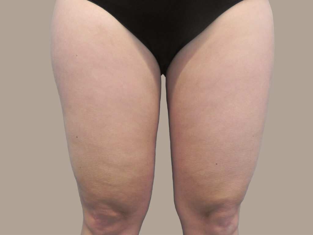 Nationaal Huidcentrum Liposuctie: veilige behandeling door ervaren chirurgen