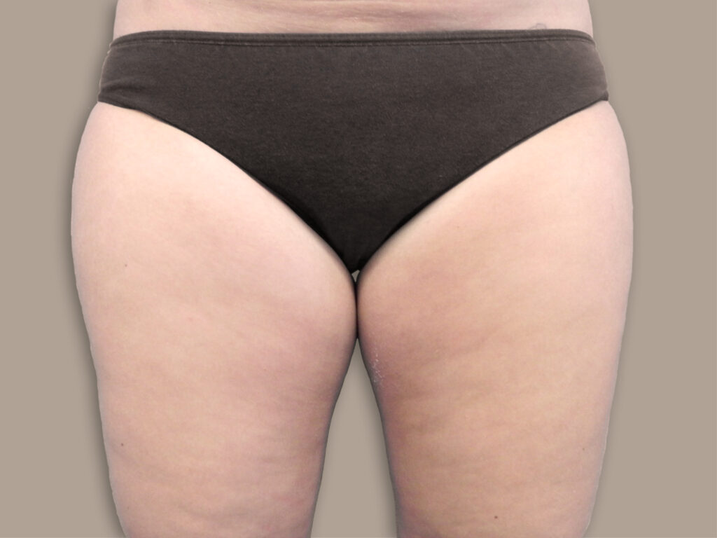 Nationaal Huidcentrum Liposuctie: veilige behandeling door ervaren chirurgen