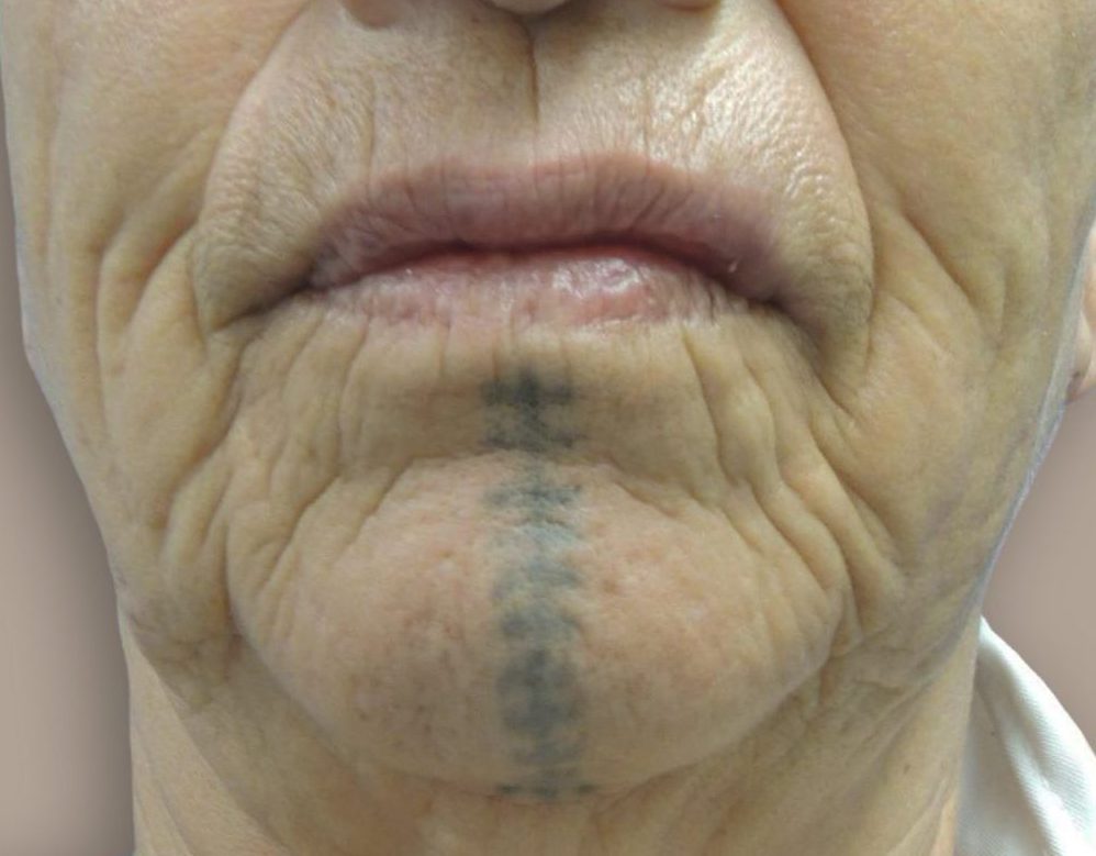 Nationaal Huidcentrum Tatoeage verwijderen: Laat je tattoo verwijderen