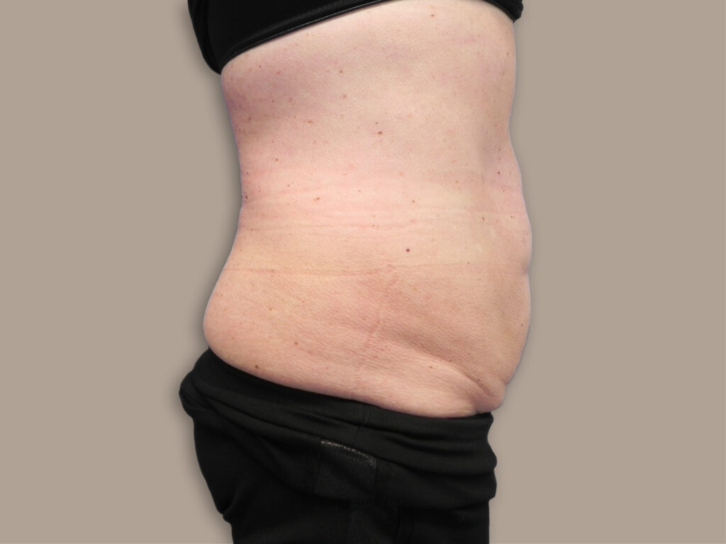 Nationaal Huidcentrum Liposuctie: veilige behandeling door ervaren chirurgen