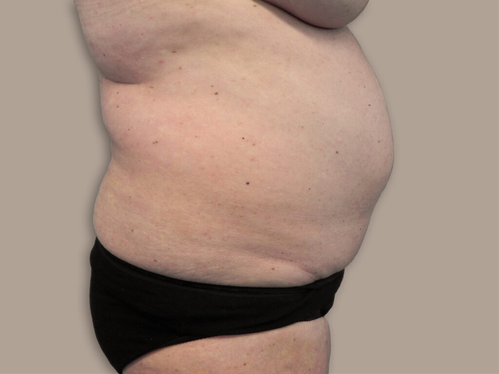 Nationaal Huidcentrum Liposuctie: veilige behandeling door ervaren chirurgen