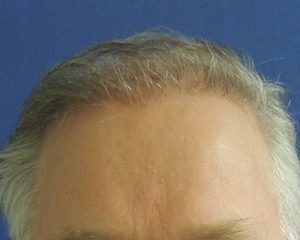 na haartransplantatie