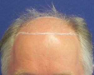 voor haartransplantatie