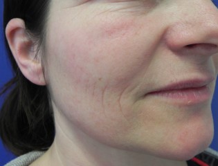 Nationaal Huidcentrum Fractionele CO2 laserbehandeling (laserpeeling)