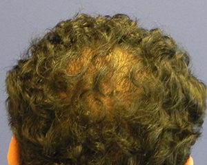 voor haartransplantatie