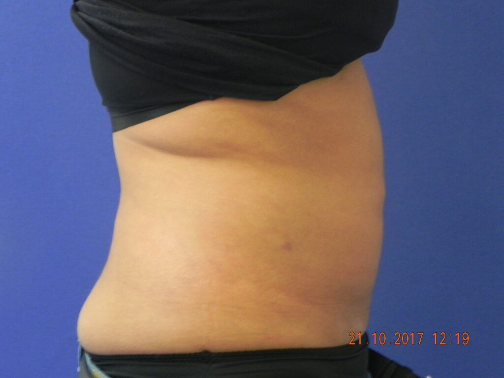 Nationaal Huidcentrum Liposuctie: veilige behandeling door ervaren chirurgen