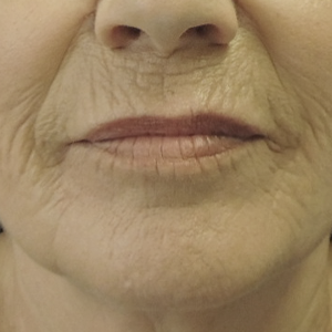 Nationaal Huidcentrum Fractionele CO2 laserbehandeling (laserpeeling)