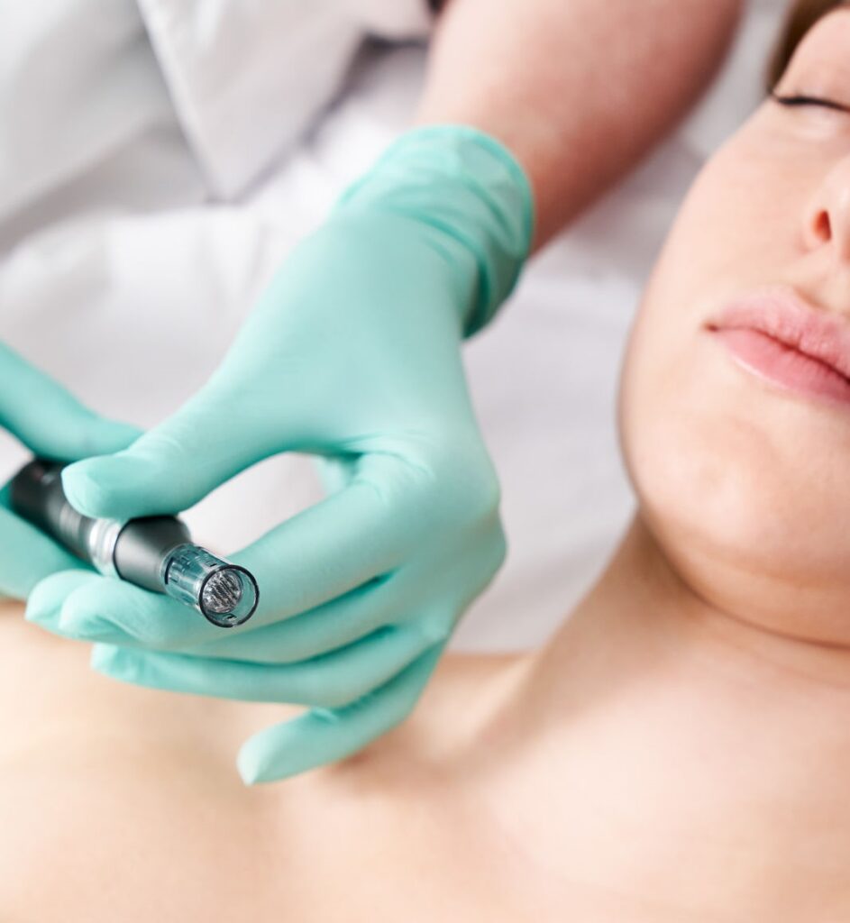 Microneedling behandeling