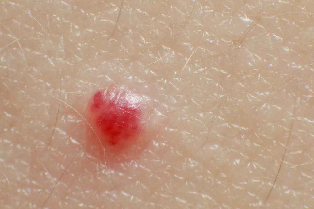 Macro close up van een kersenwratje of cherry angioma op menselijke huid