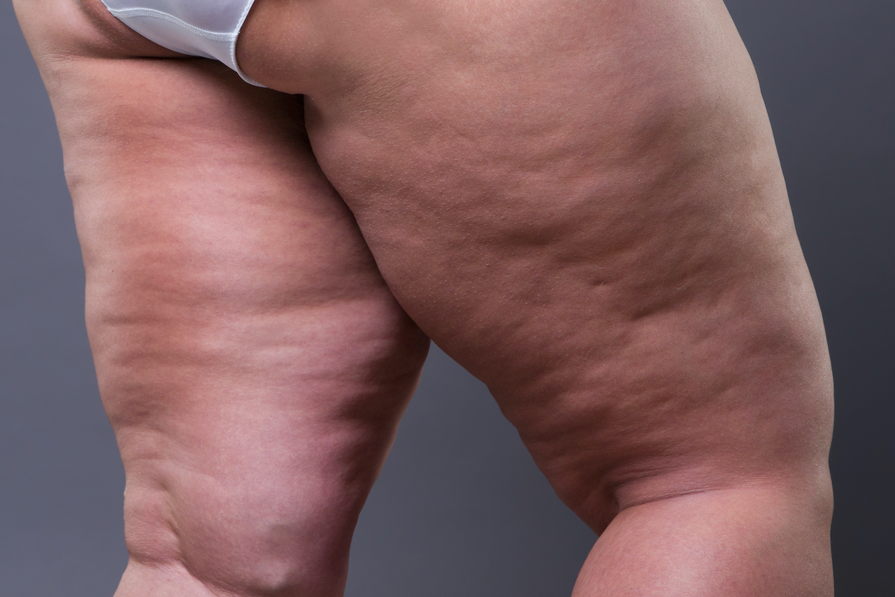 Nieuw onderzoek naar liposuctie bij lipoedeem