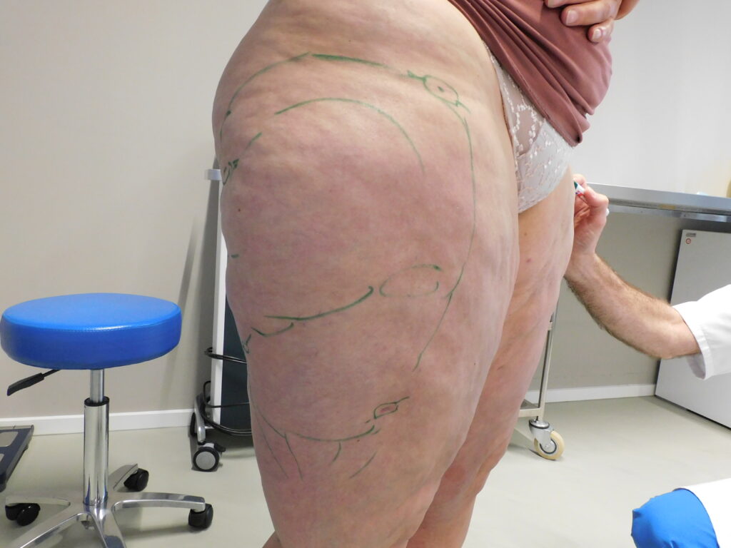 Liposuctie specialist lipoedeem