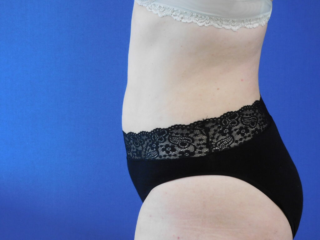 Nationaal Huidcentrum Liposuctie: veilige behandeling door ervaren chirurgen