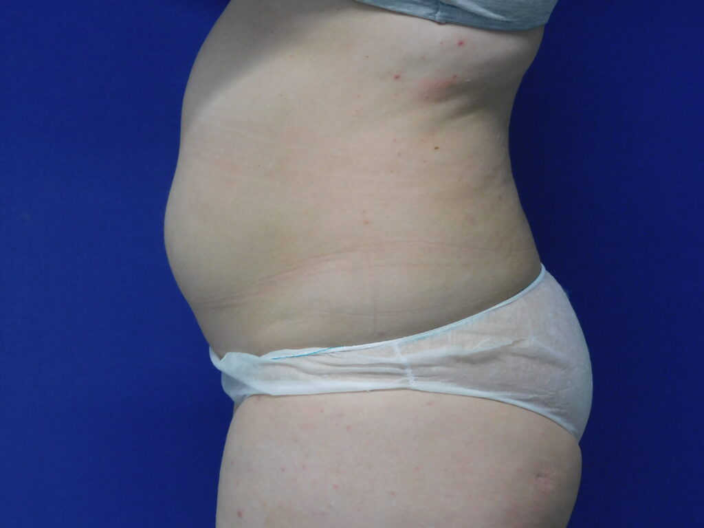 Nationaal Huidcentrum Liposuctie: veilige behandeling door ervaren chirurgen