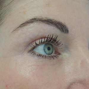 Nationaal Huidcentrum Fractionele CO2 laserbehandeling (laserpeeling)