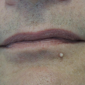 Nationaal Huidcentrum Fractionele CO2 laserbehandeling (laserpeeling)