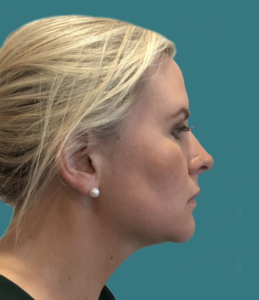 Nationaal Huidcentrum Fillers