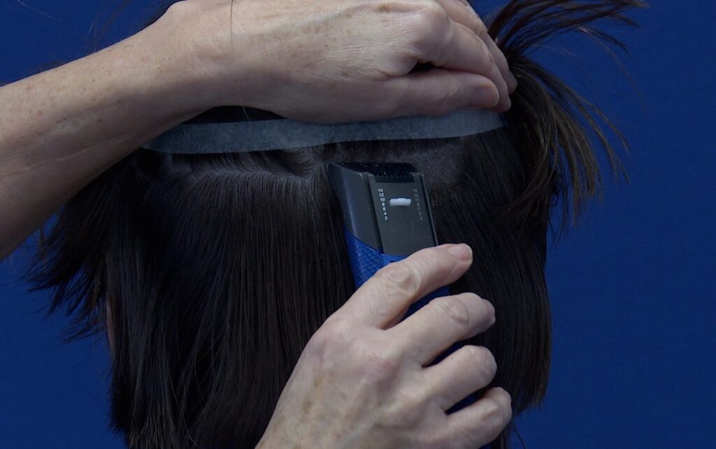 de voordelen van haarimplantatie