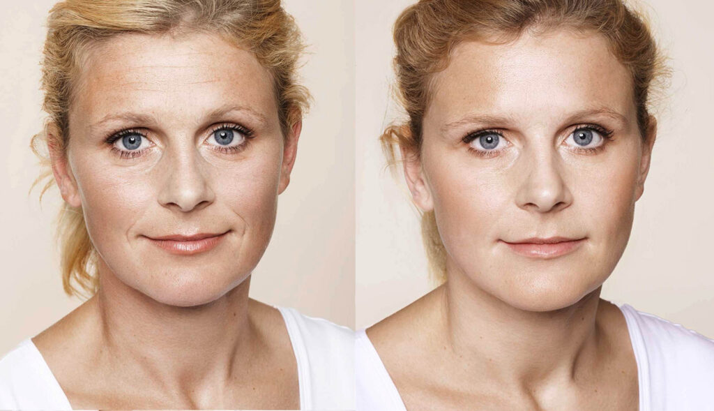 Restylane Skinbooster