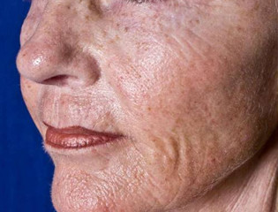 Nationaal Huidcentrum Fractionele CO2 laserbehandeling (laserpeeling)