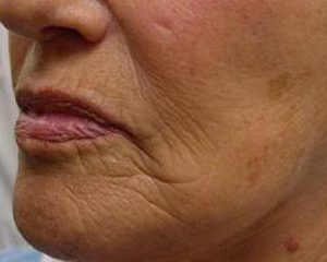 voor na receiving coolpeel treatment on hand and face