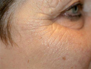 Nationaal Huidcentrum Fractionele CO2 laserbehandeling (laserpeeling)