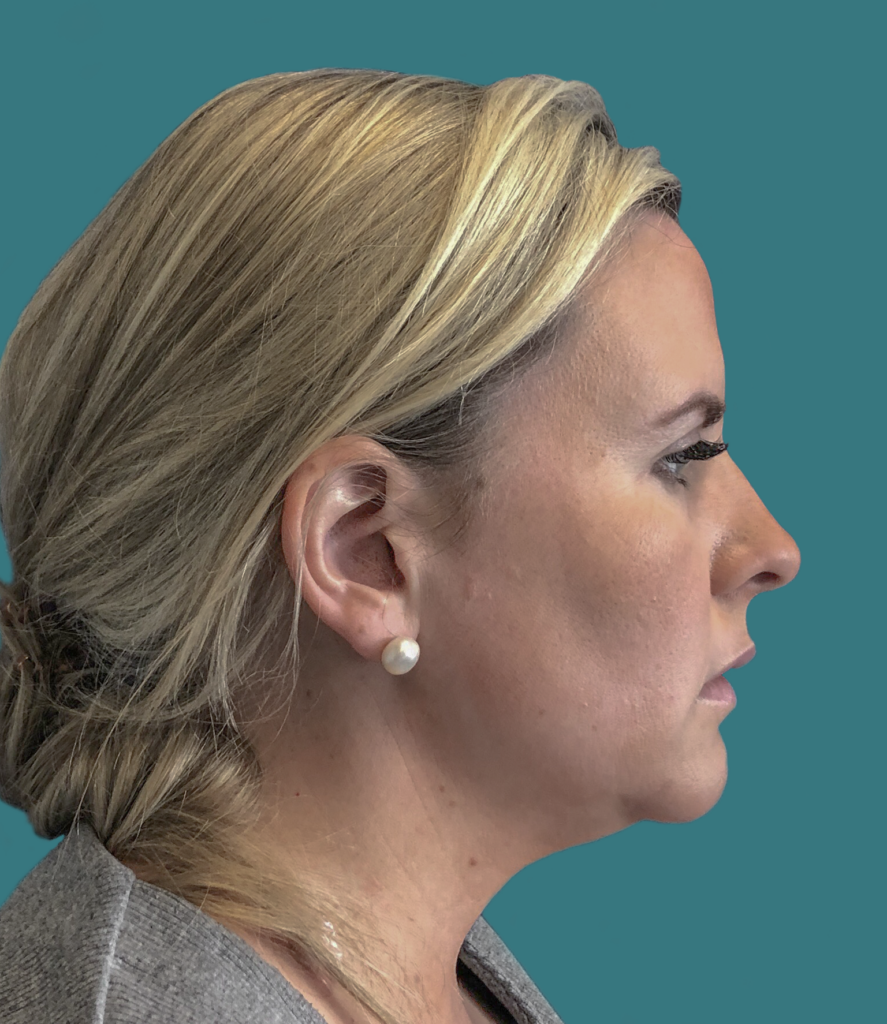 Nationaal Huidcentrum Fillers