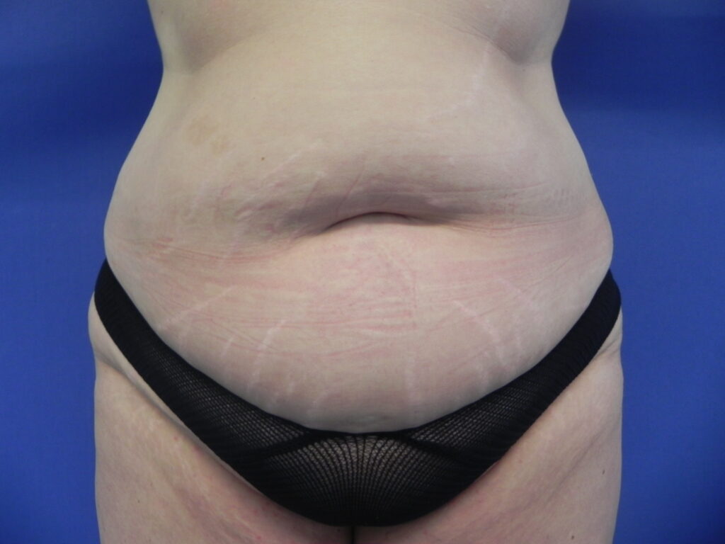 Nationaal Huidcentrum Liposuctie: veilige behandeling door ervaren chirurgen