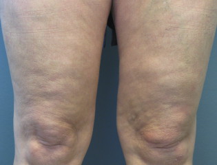 Nationaal Huidcentrum LPG endermologie