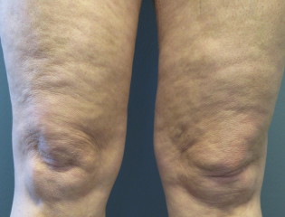 Nationaal Huidcentrum LPG endermologie