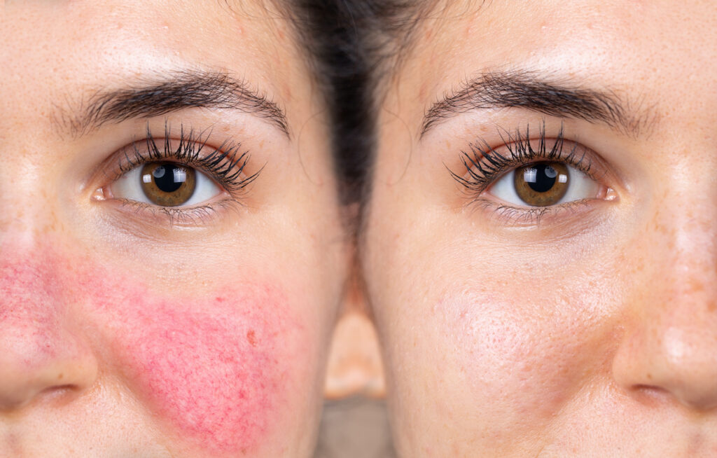 Wang van een jonge vrouw met symptomen van rosacea voor en na de behandelingen